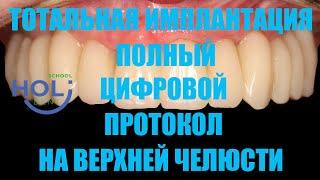 Тотальная имплантация на верхней челюсти. Полный цифровой протокол.