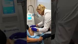 Traitement CoolSculpting - Clinique Chronos médico-esthétique