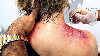 Extreme Muscle Scraping & Chiropractic Cracking *EMOTIONAL RELEASE*