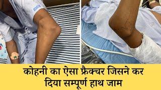 बचपन की कोहनी का फ्रैक्चर और टेड़ापन का हुआ सफल इलाज माँ हुई भावुक | Elbow Jammed Treatment