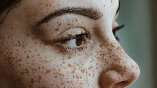 Freckles | Age-spots  LaserTreatment