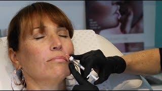 Nose to Mouth Lines Treatment