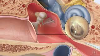 Repair a perforated ear drum using ClearDrum