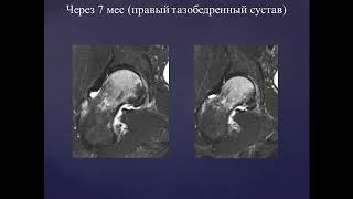Базовый курс по МРТ  Лекция «МР семиотика повреждений тазобедренного сустава»  Лектор  Учеваткин