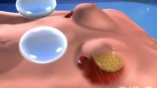 Breast Implant Surgery - 3D Medical Animation || ABP ©