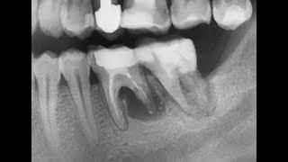 «Киста» зуба. К хирургу на удаление или к терапевту на лечение??