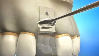 Bone Grafting Procedure Video Animation | Durham Dental Solutions