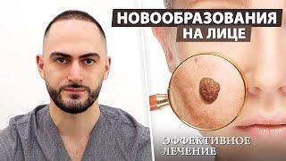 Какие новообразования на лице можно устранить?