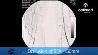 Implantation eines OptiMed sinus-Super-Flex 635 Stents in Femoralis Arterie.