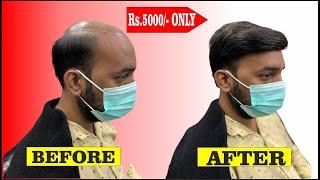 Hair Wig for men price rs.5000 only | Hair Patch price | Hair Fixing price | Hair weaving price