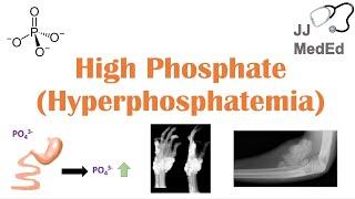 High Phosphate (Hyperphosphatemia): Dietary Sources, Causes, Symptoms, Treatment