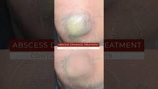 Think Abscess Drainage Treatment Is Too Good to Be True? We Have News for You | viral #shorts