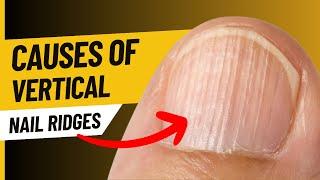 Causes of Vertical Ridges in Nails (9 Causes)