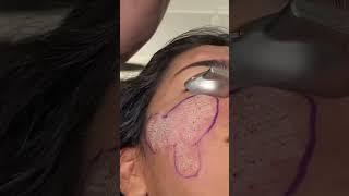 CO2 Laser Resurfacing for Acne Scarring