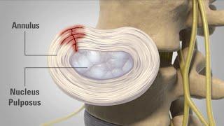 Patient Animation - Lumbar Degenerative Disc Disease