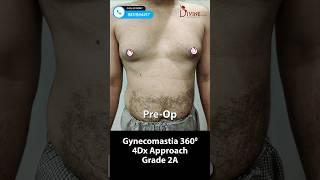 Gynecomastia Result ! Grade 2A 360° Surgery | Before and After Male Chest Reduction #shorts