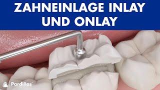 Zahneinlage Inlay und Onlay ©