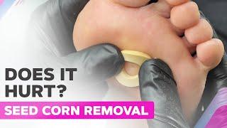 How To Remove a Seed Corn? Step-By-Step Guide
