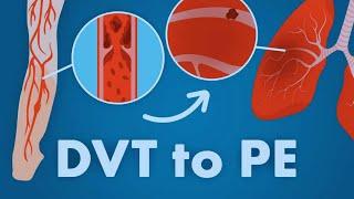 How #DVT cause #Pulmonary #embolism: within a minute