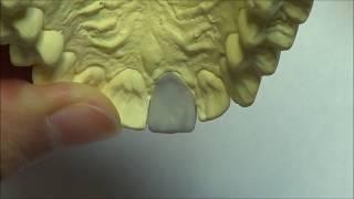 Live wax up - Upper central incisor