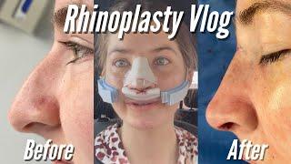 NOSE JOB VLOG - Rhinoplasty Surgery to Recovery + 3 Month Update