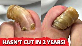 Teenager's Toenails?! Hasn't Cut Nails In 2 Years!!