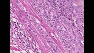 Histopathology Urinary bladder--Transitional cell carcinoma