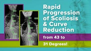 Rapid Progression of Scoliosis & Curve Reduction from 43 to 31 Degrees!