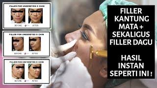 Suntik Filler Kantung Mata + Filler Dagu (Before and After) - Hasil INSTAN - Ovela Clinic Jakarta