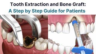 Tooth Extraction and Bone Graft: A Step by Step Guide for Patients