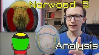 Norwood 5 Hair Transplant Expectations