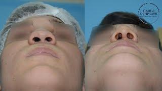 Сломанный нос? | Особенности операции у мужчин и женщин