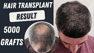 Hair Transplant Before and After | 5000 Grafts Result 12 months | Hair Transplant Timelapse