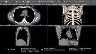 [CT] Chest | Search Pattern