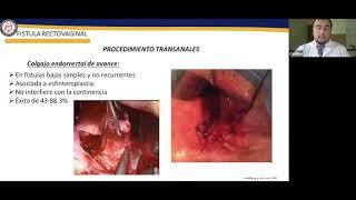 Fístulas Anorectovaginales. Postgrados de Coloproctología Integración Py-Vzla