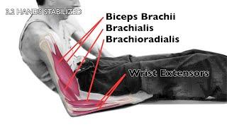 C6-C8 Quadriplegics Getting Out Of Bed Part 3: Supine to Short Sitting - Therapist Analysis