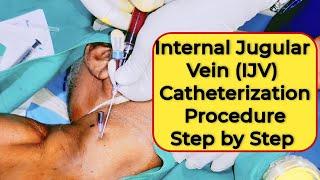 Central Line Procedure Step by Step !! CVP Line !! Internal Jugular Vein Catheterization