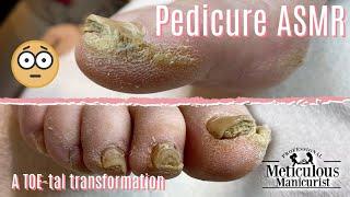 Pedicure ASMR on Extremely Calloused Feet