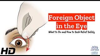 Foreign Object in the Eye: Step-by-Step Emergency Guide