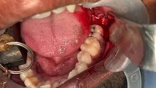 Minor oral surgery video at Richardsons NABH hospital - wisdom tooth removal made easy in India