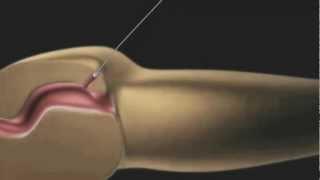 Fistula Plug Animation - Alsharq Hospital