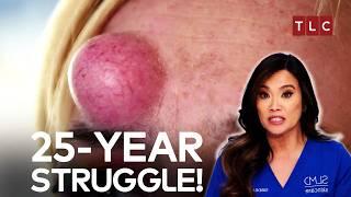 A TikTok Star’s 25-Year Bump Battle! | Dr Pimple Popper TLC