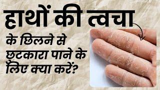 हाथों की त्वचा के छिलने से छुटकारा पाने के लिए क्या करें? Hand Skin Peeling I Home Remedies