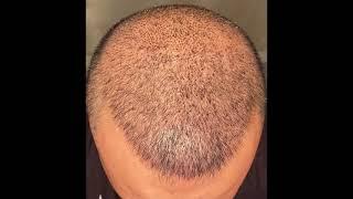 FUE Hair Transplant-  ( 4300 graft) 20 days look