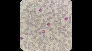 NEUTROPHILS vs LUMPHOCYTES