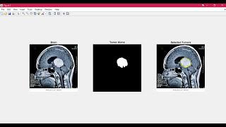 Brain Tumor Detection using Matlab - Image Processing + GUI step by step