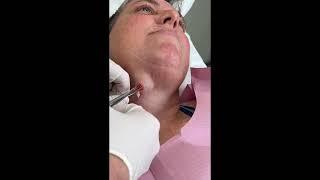 Cyst Explosion! Watch This Cyst Pop!  #PimplePopper #pimplepopping #cystpoping