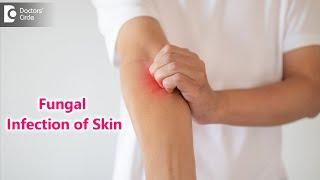 Skin Mycosis: Symptoms, Causes & Treatment | Fungal Infection - Dr. Rajdeep Mysore | Doctors' Circle