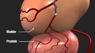 Prostatic Artery Embolization (PAE) with Magellan Robotic System