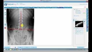 Lumbar Angles